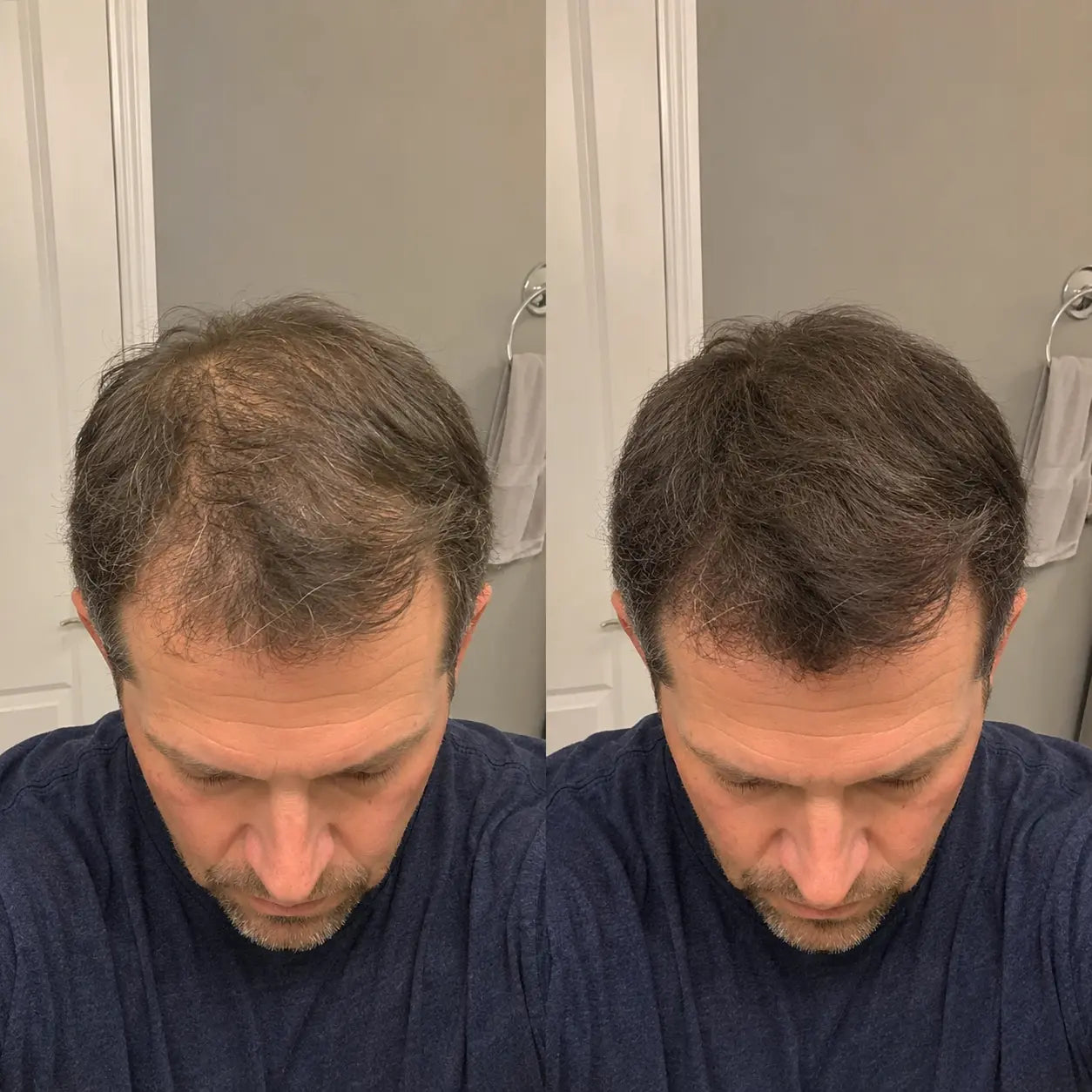 Apex Hair Men product showcase slide 9 — for receding hairline and bald spots