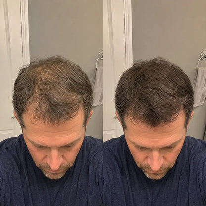 Apex Hair Men product showcase slide 9 — for receding hairline and bald spots